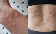 Sau bữa tiệc tất niên, người đàn ông Hà Nội nhập viện vì dị ứng  "món độc lạ "