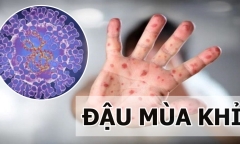 Bệnh nhân nghi mắc đậu mùa khỉ ở Đà Nẵng có kết quả xét nghiệm âm tính
