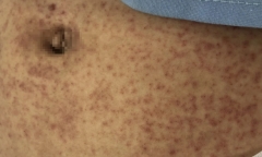 Thiếu nữ 17 tuổi rối loạn đông máu trầm trọng do mắc thủy đậu