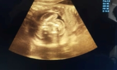 Bé 1 tháng tuổi mắc dị tật bẩm sinh cực kỳ hiếm gặp, tỷ lệ 1/500.000