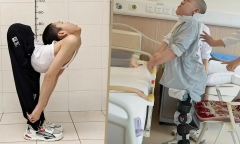 Chàng trai có cột sống gập hình chữ Z lần đầu tiên được đứng thẳng sau hơn chục năm