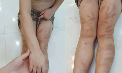 Tình hình sức khỏe mới nhất của 6 trẻ mầm non bị đánh bầm tím ở Nghệ An