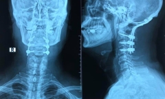 Tin tức đời sống ngày 2/8: Người đàn ông gãy đốt sống cổ vì nhảy xuống bể bơi ít nước