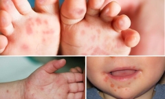 Cả nước ghi nhận 3 ca tử vong do mắc tay chân miệng 