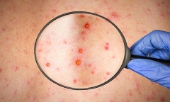 WHO họp khẩn vì bệnh đậu mùa khỉ lan rộng ở châu Âu