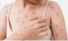 Bến Tre phát hiện ca mắc bệnh đậu mùa khỉ đầu tiên