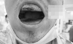 Tự mua nhựa trám răng tại nhà vì tiếc tiền đi nha khoa, người đàn ông bị dính chặt khoang miệng