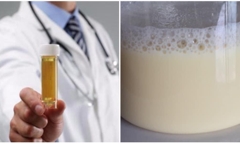 Nhiều nam giới mắc phải tình trạng nước tiểu trắng đục, để lâu đông đặc, nguyên nhân do đâu?