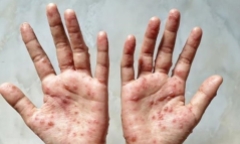 Làm cách nào để phân biệt đậu mùa khỉ và thủy đậu?