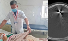 Đi qua nhà bạn chơi, bé trai 12 tuổi bị đạn bắn xuyên đầu