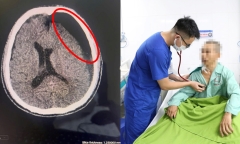 Người đàn ông bất ngờ hôn mê sau 2 tháng ngã xe đạp điện, va đầu vào trụ cổng