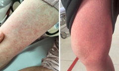 Mắc thể dị ứng mụn mủ toàn thân 