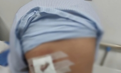 Tin tức đời sống 15/1: Đắp lá điều trị mụn lưng, người phụ nữ bị hoại tử