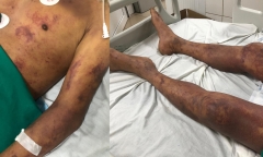 Ăn thịt lợn ốm, người đàn ông nhập viện trong tình trạng sốc nhiễm khuẩn, suy đa tạng