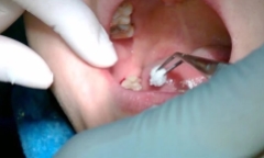 Gây tê khi nhổ răng, người phụ nữ gặp biến chứng nguy hiểm