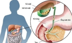 Sỏi túi mật hình thành do đâu và cách kiểm soát hiệu quả