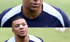 Nguyên nhân khiến Mbappe chưa đeo mặt nạ sau sự cố gãy mũi là gì?