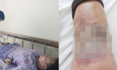 Bôi dầu nóng chữa gãy chân, người đàn ông nhiễm trùng da nặng