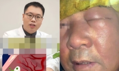 Người đàn ông mặt sưng phù, nhiễm trùng nặng do thói quen nhiều người mắc phải