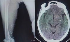 Hình ảnh chụp CT gây sốc của bệnh nhân nhiễm sán não do thói quen ăn đồ sống