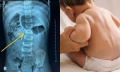 Gia tăng tình trạng trẻ bị gù vẹo cột sống do sai lầm nhiều bố mẹ gặp phải