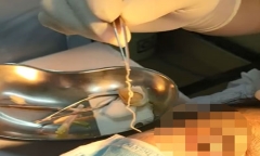 Kinh hãi phát hiện giun dài 10cm ngoe nguẩy trong mắt người phụ nữ