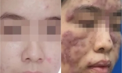 Tin lời “bác sĩ online”, cô gái trẻ  bị biến dạng gương mặt và có nguy cơ bị mù 