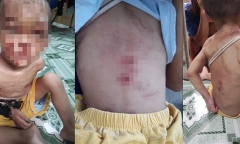 Sức khỏe bé trai nghi bị bạo hành ở TP.HCM hiện ra sao?