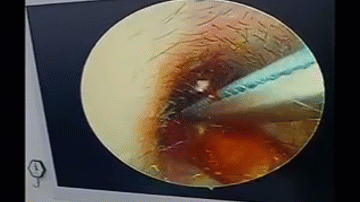 Clip: Thấy khó chịu trong tai, người đàn ông đi kiểm tra phát hiện 