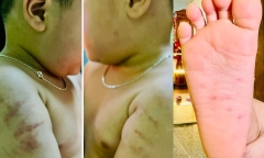 Vụ bé gái 4 tuổi nghi bị bạo hành ở Bình Định: Người thân hé lộ tình trạng sức khỏe