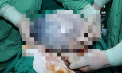 Tin tức đời sống ngày 1/8: Ngỡ ngàng sản phụ sinh đôi, một bé còn trong bọc ối