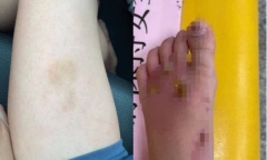 Thuê bảo mẫu chăm sóc con trai, người mẹ sốc nặng khi phát hiện cơ thể tàn tạ của đứa trẻ