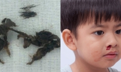 Xử lý chảy máu cam sai cách, cháu bé suýt mất mạng