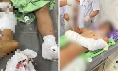 Đắk Lắk: Bé trai 12 tuổi dập nát bàn tay do chế pháo trên mạng dẫn đến phát nổ