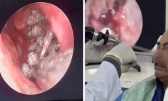 Kinh hãi cảnh người đàn ông bị hơn 100 con giòi làm tổ trong hốc mũi