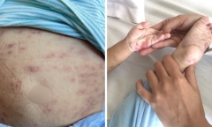 Mắc hội chứng hiếm gặp, bé 1 tuổi nổi hàng trăm bóng nước khắp cơ thể