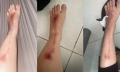 Tham gia tiệc cuối năm, người phụ nữ bị bỏng vì tiết mục bắn pháo hoa
