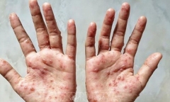 Phát hiện ca bệnh đầu tiên nghi mắc đậu mùa khỉ tại Cà Mau