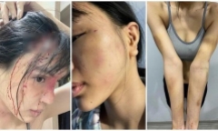 Vụ nữ siêu mẫu tố chồng chưa cưới hành hung: Công an vào cuộc xác minh