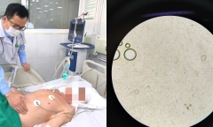 Nhiễm giun lươn lan tỏa, cụ ông 72 tuổi nguy cơ tử vong cao