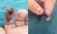 Kẹp tay vào cửa kính ở siêu thị, bé gái 3 tuổi bị thương nghiêm trọng ở ngón tay