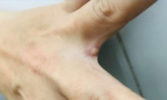 Sức khỏe của bệnh nhân mắc đậu mùa khỉ đầu tiên ở Việt Nam hiện ra sao?