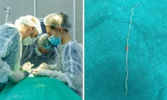 Ký sinh trùng dài 15cm trong mắt người đàn ông sau khi bị muỗi đốt