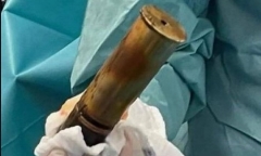 Bệnh viện vội sơ tán khi cụ ông đến khám với quả đạn pháo trong trực tràng