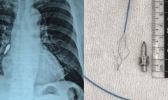 Từ “cửa tử” trở về: Những ca đột quỵ hồi phục kỳ diệu trong đợt giá rét