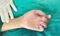 Tây Ninh: Nghịch dao cắt cỏ, bé trai 12 tuổi suýt mất 2 ngón tay 