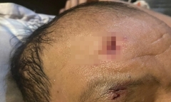 Hà Nội: Chó dại nặng 15 kg tấn công nhiều người 