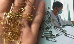 Sốt nhưng không khỏi, bé 10 tháng tuổi bị phát hiện hóc thứ 