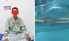Người đàn ông thủng đại tràng vì thói quen nhiều người Việt mắc phải