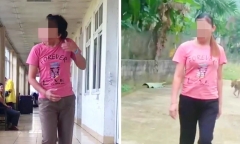 Lấy lại vận động cho người phụ nữ mắc căn bệnh khiến đầu luôn xoay sang phải